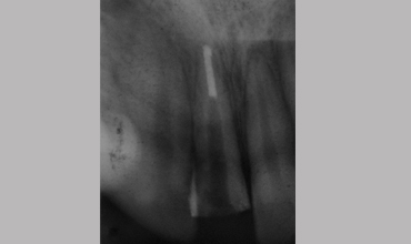 Dental jewellery treatment in Anand
                    